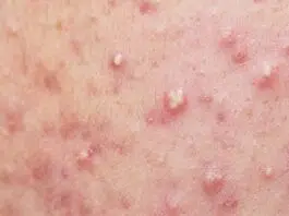 Comment traiter l’acné naturellement ?